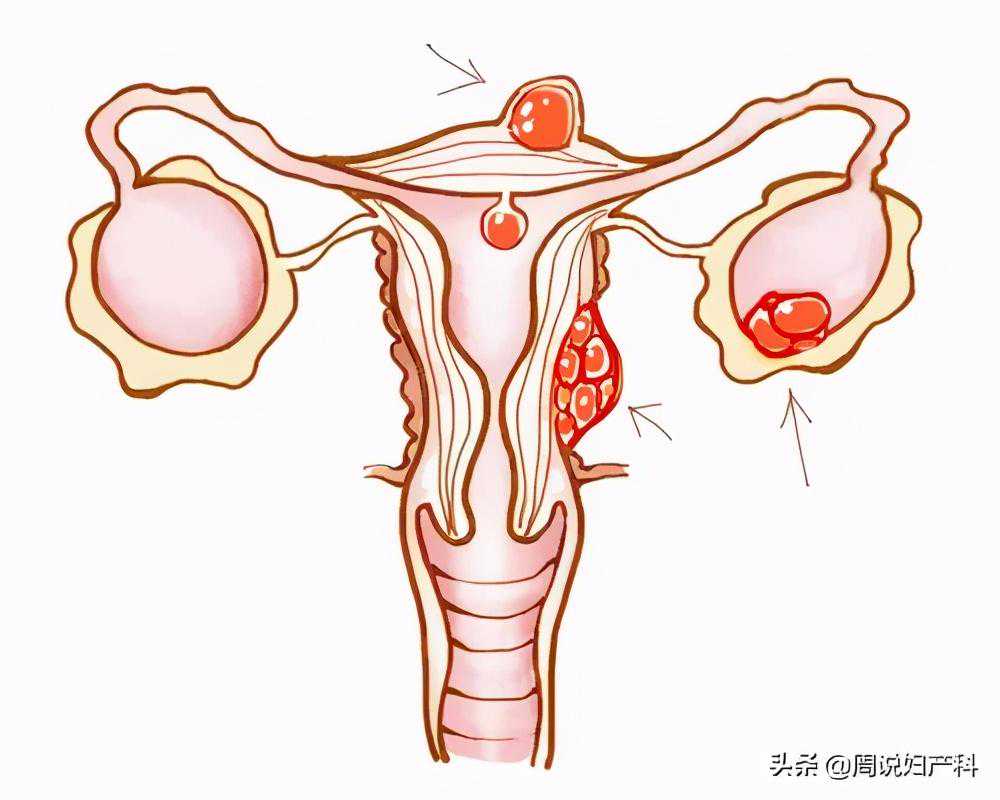 香港妇产科验血生男孩还是女孩,子宫内膜增生一般常发生于围绝经期妇女，是