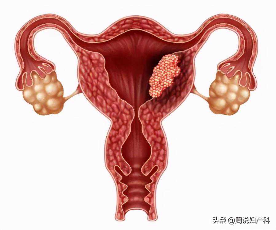 香港妇产科验血生男孩还是女孩,子宫内膜增生一般常发生于围绝经期妇女，是